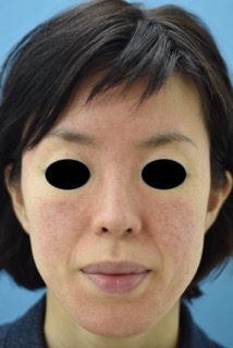 アイコンＭＡＸＧによる赤ら顔治療の症例写真（治療前）　214px