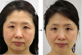 輪郭注射による小顔治療の症例写真