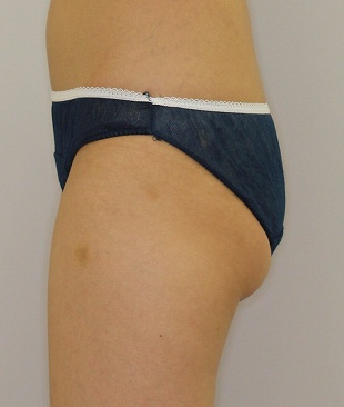 ライポソニックスによるお尻下部＋太もも付け根の痩身治療（施術前　左側から）310px