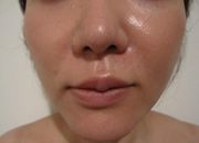 ウルトラアクセントによる小顔治療の症例写真（治療途中）　180px
