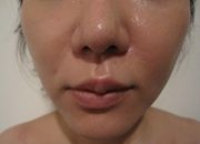 ウルトラアクセントによる小顔治療の症例写真（５回治療後）　180px