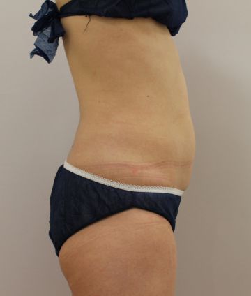 クールスカルプティング治療　下腹部（施術３ヶ月後）360px