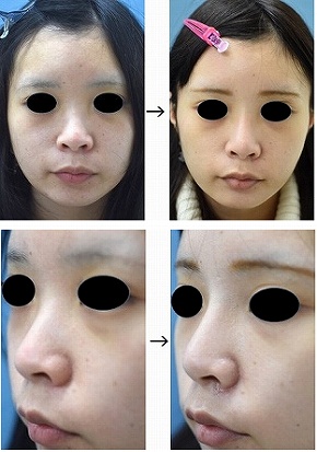 Ｉ型プロテーゼによる鼻を高くする手術の症例写真