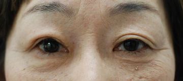 腱膜性眼瞼下垂手術の症例写真（片目のみ保険適応の事例：手術から1ヶ月後）360px