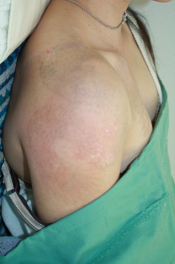 レーザーによるカラー刺青除去の症例写真（治療後）　360px
