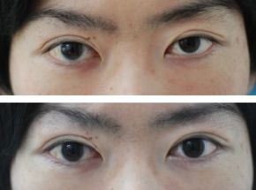右の眼瞼下垂手術・腱膜前転術（自由診療）の症例写真