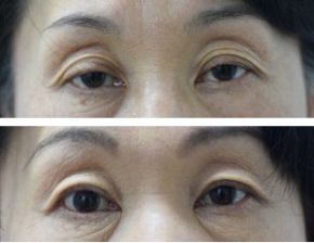 両目の眼瞼下垂症手術・腱膜前転術（保険診療）の症例写真