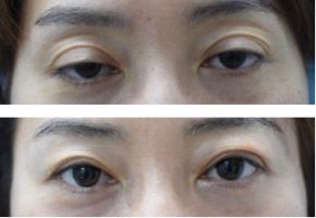 両目の眼瞼下垂手術・腱膜前転術（保険診療）の症例写真