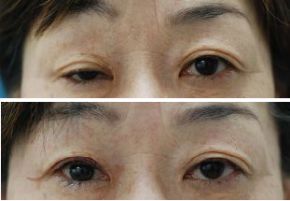 右の眼瞼下垂手術・腱膜前転術（保険診療）の症例写真