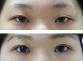 両目の眼瞼下垂手術・腱膜前転術（自由診療）の症例写真