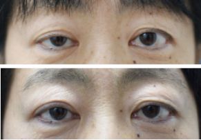 右目の眼瞼下垂手術・腱膜前転術（保険診療）の症例写真