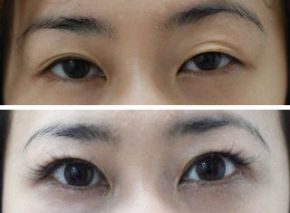 両目の眼瞼下垂手術・右（自由診療）、左（保険診療）の症例写真