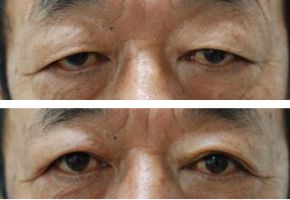 両目の眼瞼下垂手術・腱膜前転術+皮膚切除　（保険診療）の症例写真