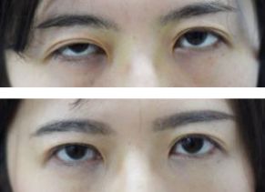 右目の先天性眼瞼下垂手術・腱膜前転術（保険診療）の症例写真
