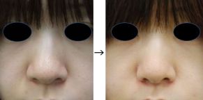 鼻翼縮小・外側切除（小鼻を小さくする）の症例写真