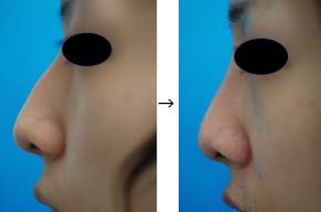 鼻ハンプ削り（ワシ鼻修正）の症例写真