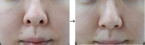 鼻孔縁下降術（鼻の穴を目立たなくする）の症例写真