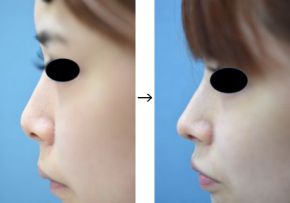 鼻尖耳介軟骨移植（鼻先を高くする）の症例写真