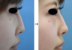 鼻中隔延長（鼻先を前に出す）の症例写真