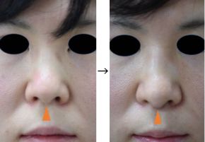 鼻柱延長（鼻柱を下に出す）の症例写真