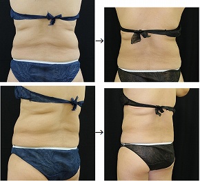 複数の医療痩身マシーンを使用した症例写真（背中）