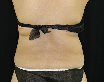 リポコントラストとゼルティックによる背中痩身治療（施術４ヶ月後背面）　360px
