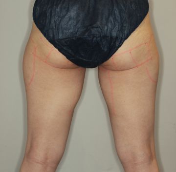 ゼルティックとライポソニックスによる大腿～臀部痩身治療（施術デザイン）　360px