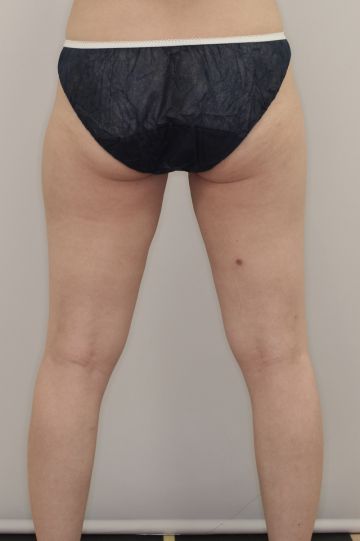 ゼルティックとライポソニックスによる大腿～臀部痩身治療（２回施術後）　360px