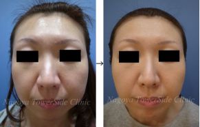 メスを使わない頬のたるみ複合治療の症例写真