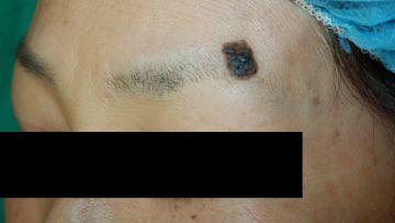 メス切除縫合によるホクロ除去の症例写真（手術前）　360px