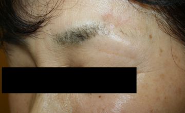 メス切除縫合によるホクロ除去の症例写真（手術から約１年後）　360px