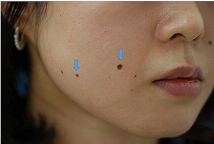 ホクロを薄くするレーザーの症例写真（１回目治療後右側）310px