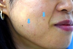 ホクロを薄くするレーザーの症例写真（２回目治療後右側）310px