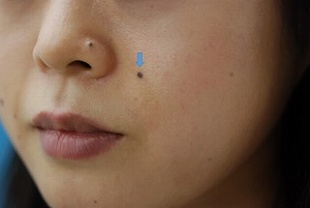 ホクロを薄くするレーザーの症例写真（治療前左側）310px