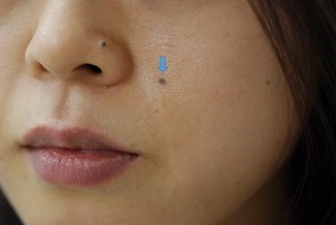 ホクロを薄くするレーザーの症例写真（１回目治療後左側）310px