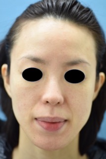 アイコンＭＡＸＧによる赤ら顔治療の症例写真（治療後）　214px