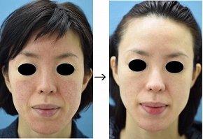 アイコンmaxGの赤ら顔治療症例写真