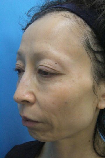 ウルセラの症例写真（左側　治療前）　360px