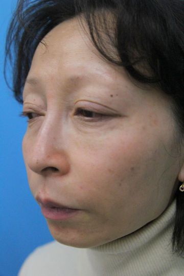 ウルセラの症例写真（左側　治療3ヶ月後）　360px