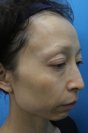 ウルセラの症例写真（右側　治療前）　360px