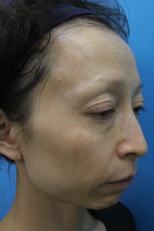 ウルセラの症例写真（右側　治療前）　310px