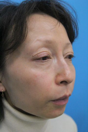 ウルセラの症例写真（右側　治療3ヶ月後）　360px
