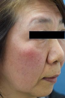 Ｖビーム2を使用した赤ら顔治療の症例写真（治療前）214px
