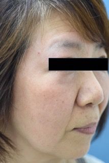 Ｖビーム2を使用した赤ら顔治療の症例写真（初回照射から３ヶ月目）214px