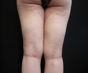 イタリアンシェイプによる太ももの裏のセルライト治療（治療前）310px