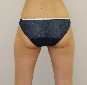 ライポソニックスによるお尻下部＋太もも付け根の痩身治療（施術３ヶ月後　後ろから）360px