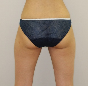 ライポソニックスによるお尻下部＋太もも付け根の痩身治療（施術３ヶ月後　後ろから）310px