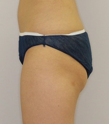 ライポソニックスによるお尻下部＋太もも付け根の痩身治療（施術３ヶ月後　左側から）360px