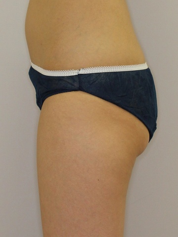 ライポソニックスによるお尻下部＋太もも付け根の痩身治療（施術６ヶ月後　左側から）360px