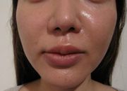 ウルトラアクセントによる小顔治療の症例写真（治療前）　180px